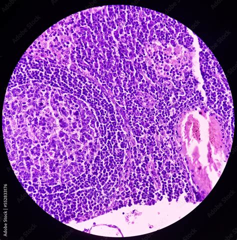 High grade mucoepidermoid carcinoma of parotid cyst. Microscopic show parotid tissue, features ...