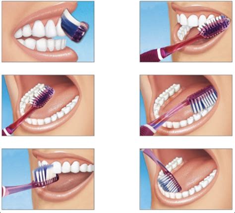 Brushing Technique Poster