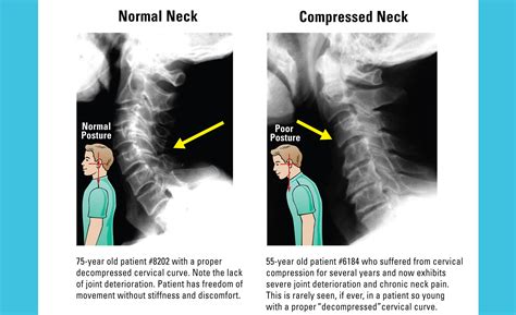 Studies on Bulging Disk & Neck Pain – Posture Pro, Inc.