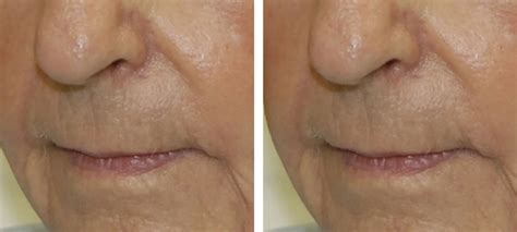 Lines and Wrinkles | Before & After | Kingsway Dermatology