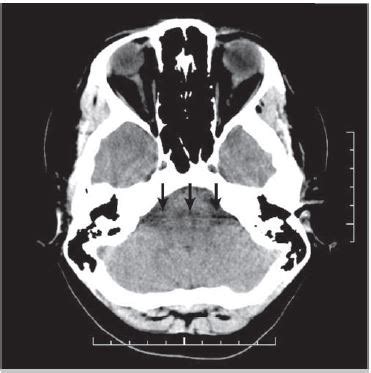 CT Scan Artifacts - RadTechOnDuty