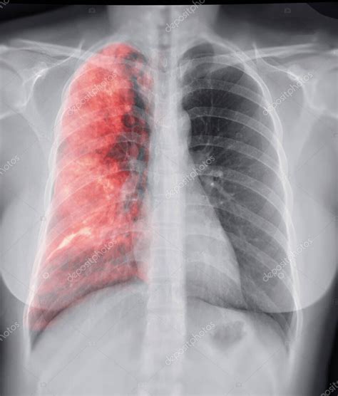 "Chest X-ray with Lung 3D rendering image for diagnosis TB,tuberculosis and covid-19 ." 2024