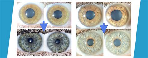 Dangers of eye color change with keratopigmentation