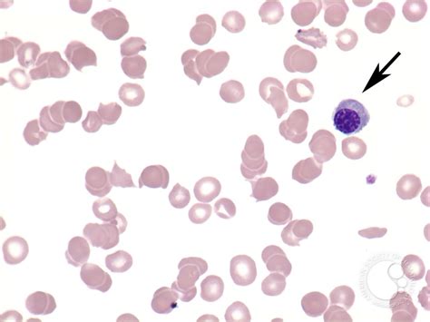 Microangiopathic hemolytic anemia - 3.