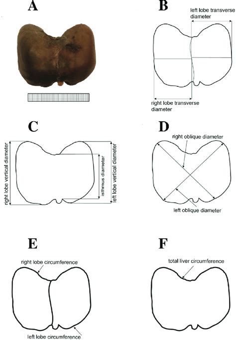 Measurements of the liver in the anterior projection: (A) diaphragmatic... | Download Scientific ...