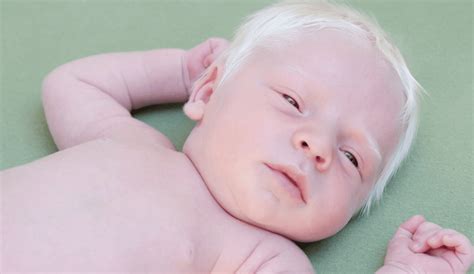 Upbeat News - This Baby Was Born With White Hair And Doctors Had No Idea Why