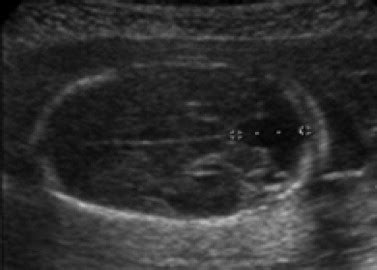 Cisterna Magna Ultrasound