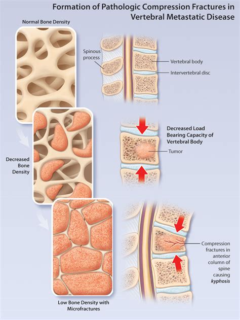 metastatic epidural spinal cord compression | HealthPlexus.net