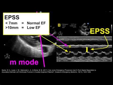 Student Case: "The Precordial Thump" - PA Student General Discussion - Physician Assistant Forum