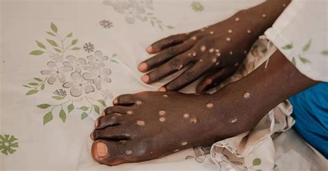 Mpox sufferer details painful symptoms to look for as horror virus ...