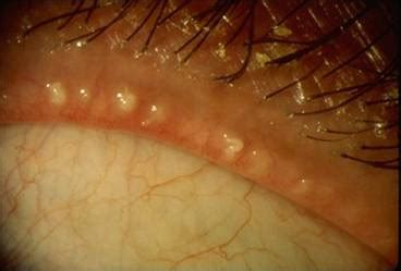 Meibomian Gland Dysfunction - Scher&Ward