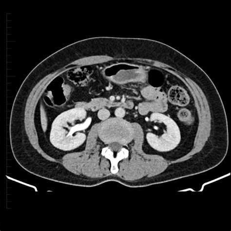 CT Scan of the Kidney | Melbourne Radiology