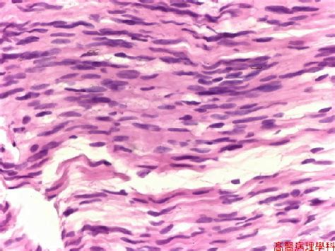 Neurilemmoma; Neurinoma; Schwannoma; Neurilemmosarcoma; Malignant ...