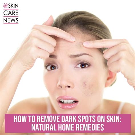 How To Remove Dark spots On Skin: Natural Home Remedies - Skin Care Top ...