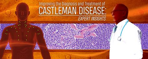 Updates in the Diagnosis and Treatment of Castleman Disease: Expert ...