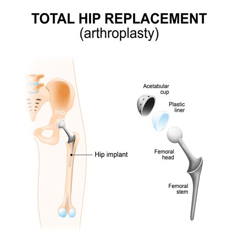 Types of Hip Replacement Surgery in the UK - The Best Of Health