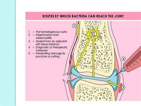 Septic Arthritis