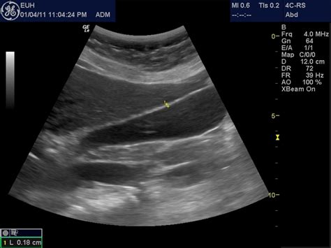 Acute Cholecystitis ~ Ultrasound Cases Info