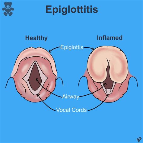 Swollen Epiglottis In Children