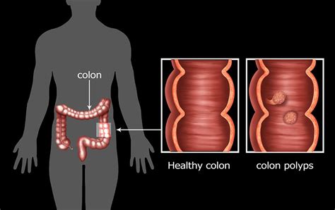 Colonic Polyps | Oxford Gut and Liver