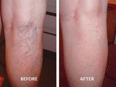 Laser Vein Removal for Omaha & Papillion, NE | Preventative Medical Clinic