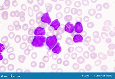 Moderate Blast Cell of White Blood Cells in Blood Smear Stock Image - Image of cell, hematology ...