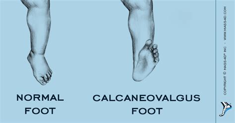 What Is A Calcaneovalgus Foot? - MASS4D® Foot Orthotics