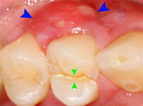 Bump on gums: Causes and how to treat them | Swollen gum, Gum sores ...