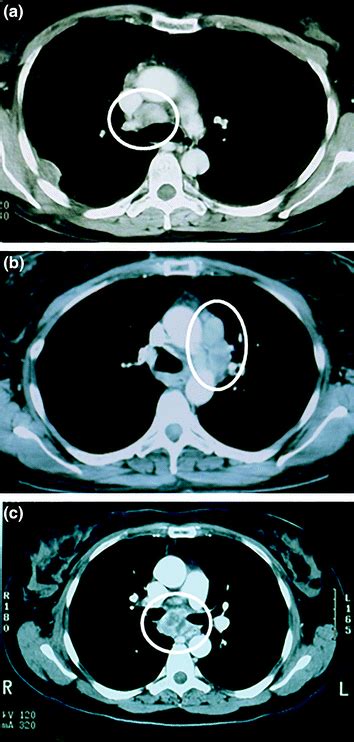 Mediastinal Biopsy Techniques | Basicmedical Key