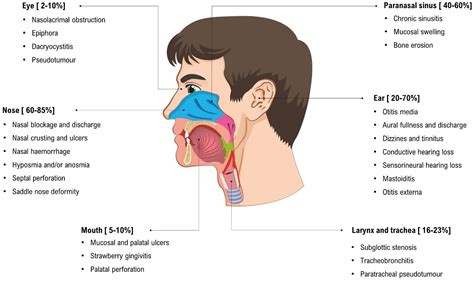 Ear, nose, and throat in ANCA-associated vasculitis: a comprehensive review