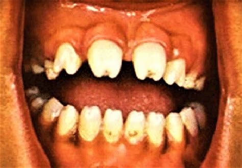 Hutchinson's teeth causes, diagnosis & treatment