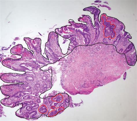 Representative images of structural atypia area (red-lined inner area)... | Download Scientific ...