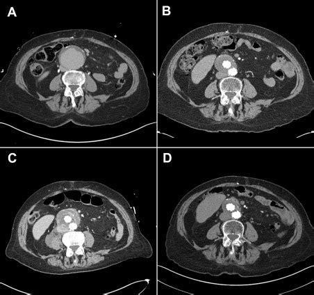 Recanalization of previously thrombosed type II endoleak with aneurysm ...