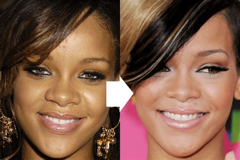 Rihanna Forehead Reduce Size Surgery Before And After Photos