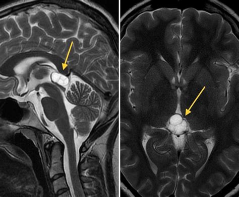 Pineal cyst development and treatment - full information