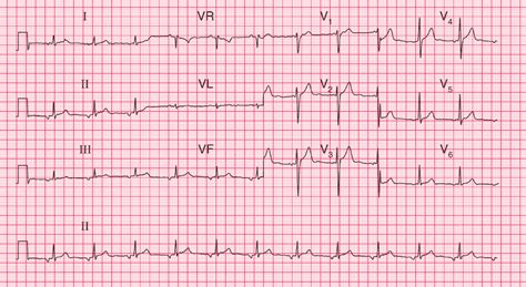 Ectopic Atrial Tachycardia Ecg