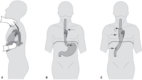 Mckeown Procedure - Minimally invasive Mckeown esophagectomy with ...