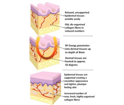 RF Skin Tightening in Melbourne | Bay Medical Aesthetics