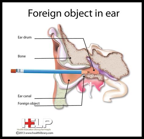 Foreign Object in Ear | Ear | Pinterest