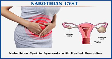 Nabothian cyst symptoms Archives - Planet Ayurveda