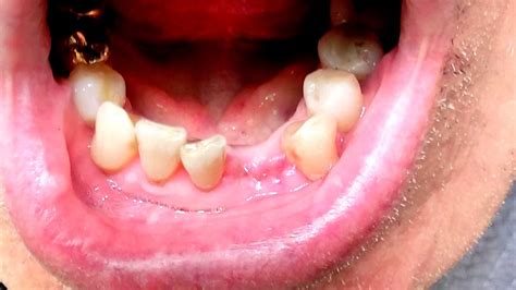 Treatment For Dry Socket After Tooth Extraction - Sock Choices