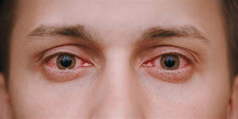 Indications of Eye Problems, Signs, Symptoms | Neoretina