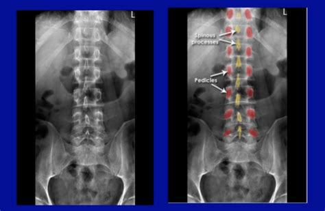 A Review on Reading Lumbar X-rays - Sports Medicine Review