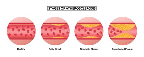 Atherosclerosis Diagram - vrogue.co