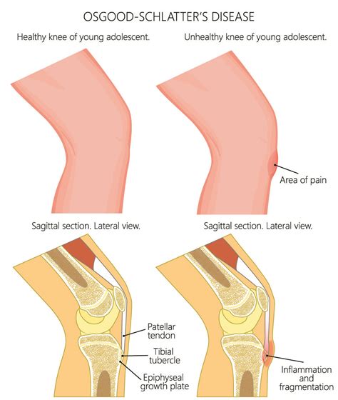 Can Osgood-Schlatter Disease Affect Adults?