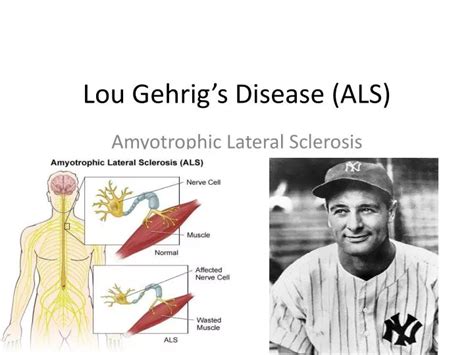 PPT - Lou Gehrig’s Disease (ALS) PowerPoint Presentation, free download ...