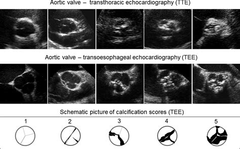 kopfüber auf der anderen Seite, Ausfall tee aortic valve cusps ...