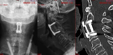 Anterior Cervical Corpectomy and Fusion (ACCF) - Joshua Li, MD, PhD