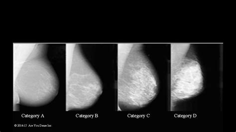 MAMMOGRAMS MISS 40% OF CANCER - YouTube