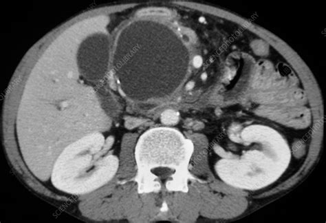 Pancreatic pseudocyst, CT scan - Stock Image - C018/7156 - Science Photo Library